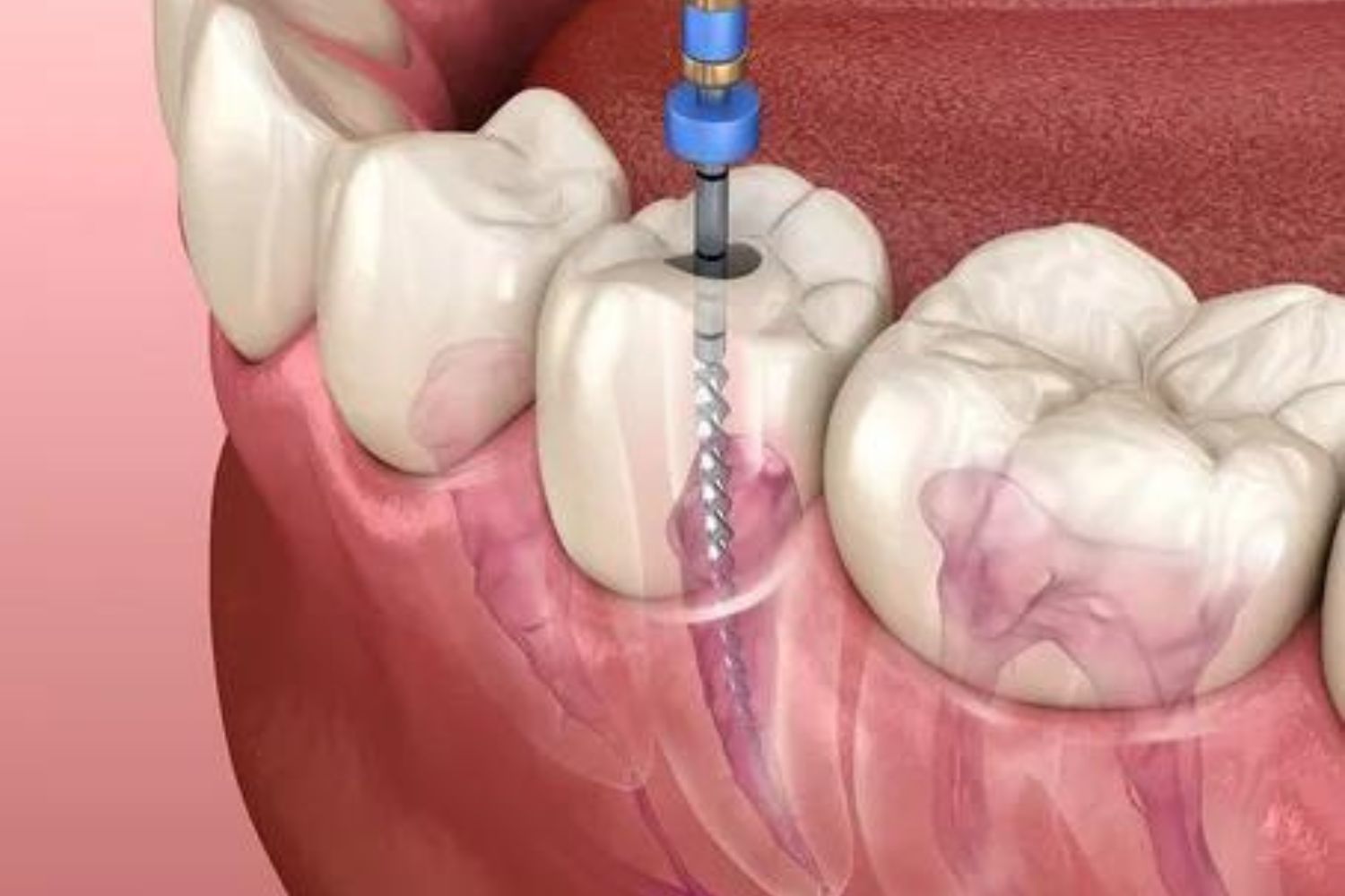 First care Dental - Root Canal Treatment